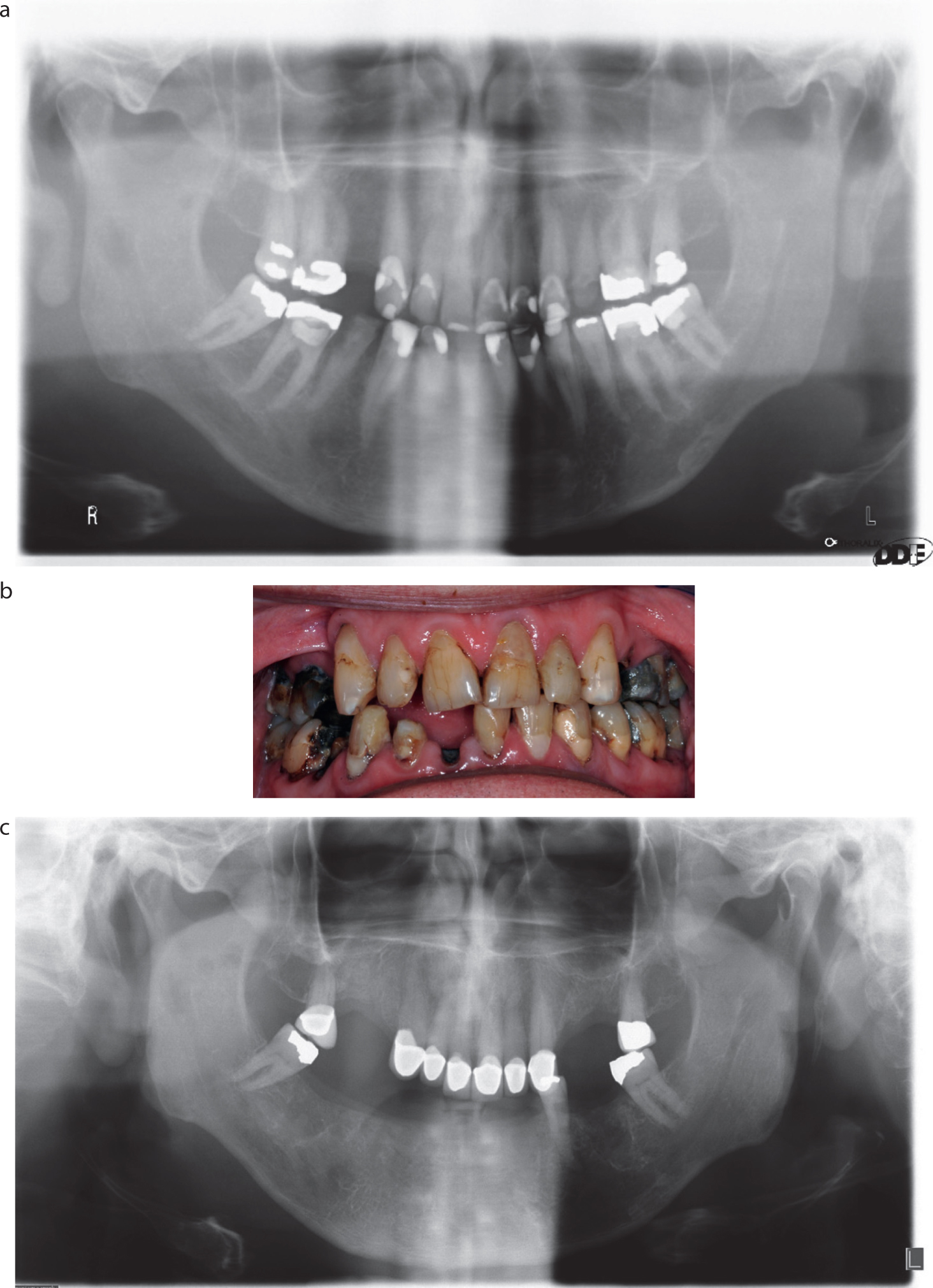 Dental Update - An update on radiation caries