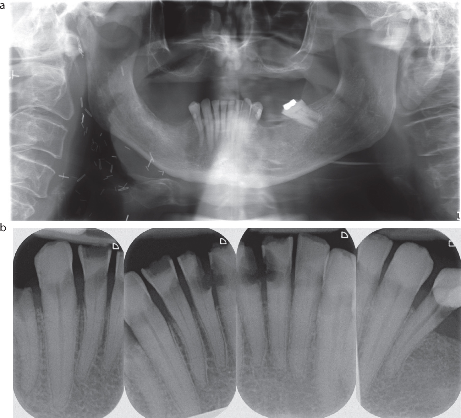 Dental Update - An update on radiation caries