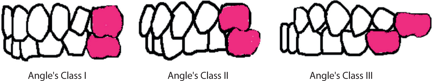 Angle Classification
