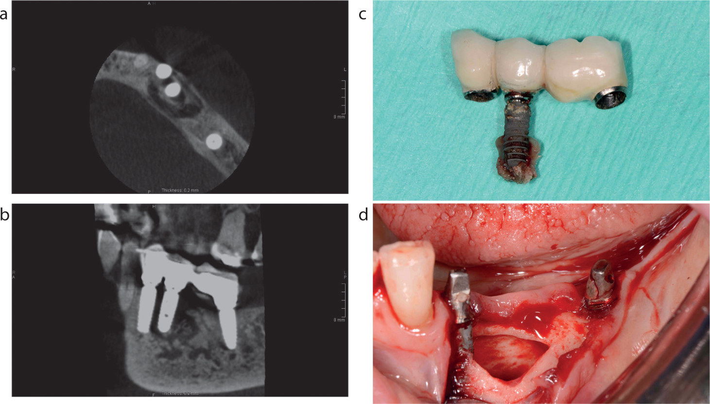 Cleaning under a pontic with Superfloss.