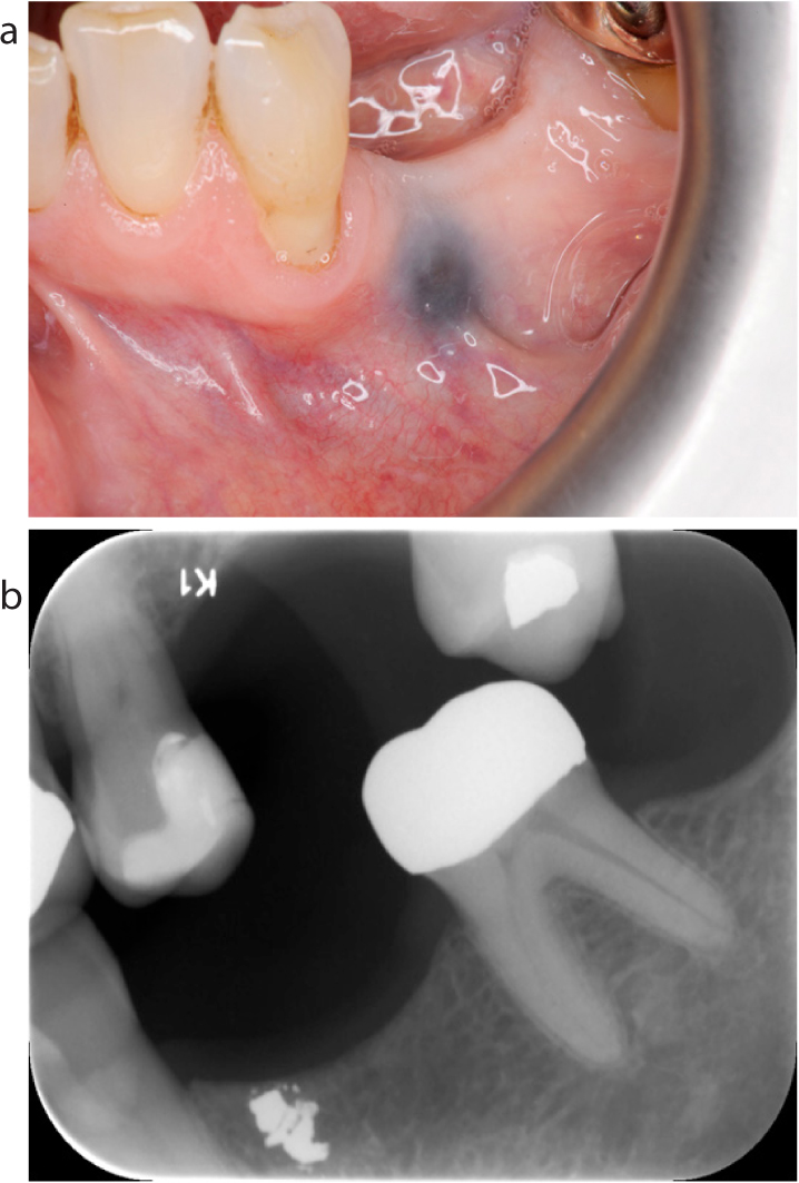 An Overview of Amalgam Tattoos for the Dental Hygienist - Today's RDH