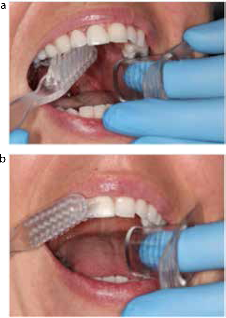 DIY Partials(Teeth) : 7 Steps - Instructables