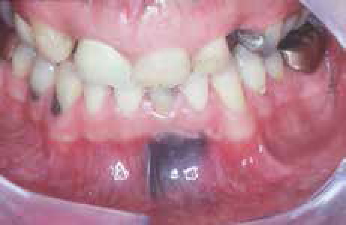 Aggregate 103+ dental amalgam tattoo super hot