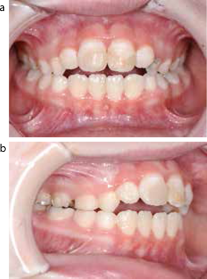 Teeth from shop pacifier use